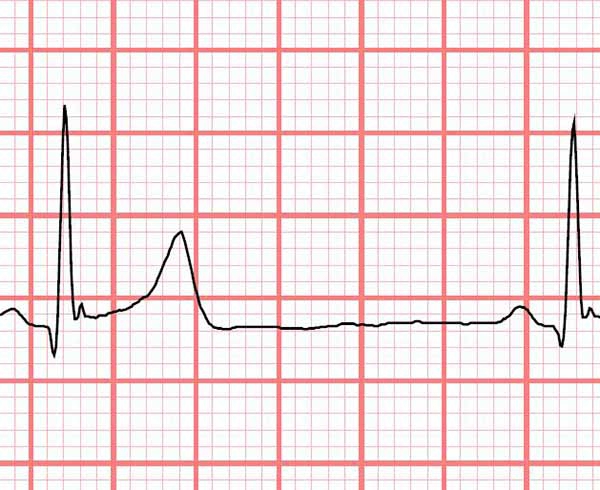 ECG