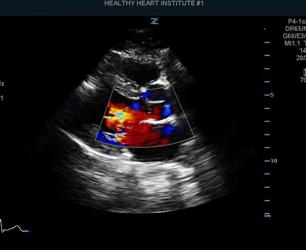 Echocardiogram