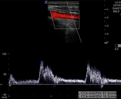 Carotid Doppler