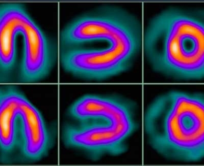 Myocardial Perfusion Imaging (MPI) Test